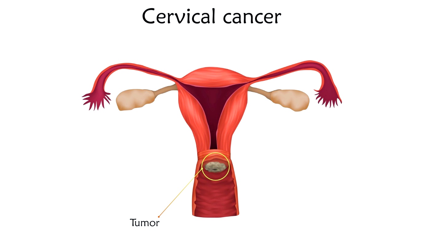 What are the causes of cervical cancer