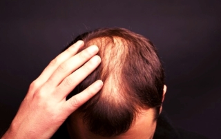 ছেলেদের চুল পড়ার কারণ কি? (ছেলেদের চুল পড়ার প্রতিকার) 22 ছেলেদের চুল পড়ার কারণ কি