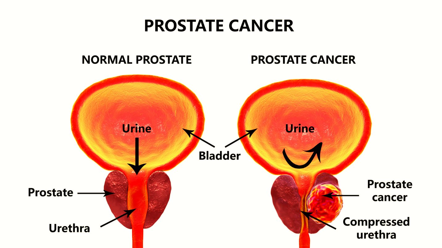 types of Prostate cancer types of Prostate cancer
