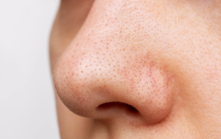 ব্ল্যাকহেডস দূর করার ১০ টি উপায় 10 ব্ল্যাকহেডস দূর করার উপায়