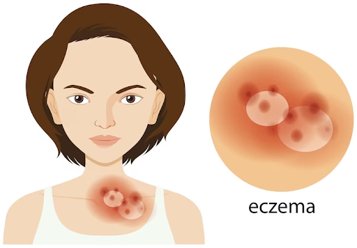 Eczema