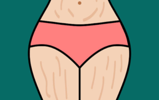 স্ট্রেচ মার্কস বা ফাটা দাগ থেকে পরিত্রান পেতে ১০ টি উপাদান 17 Remedies for Stretch Marks