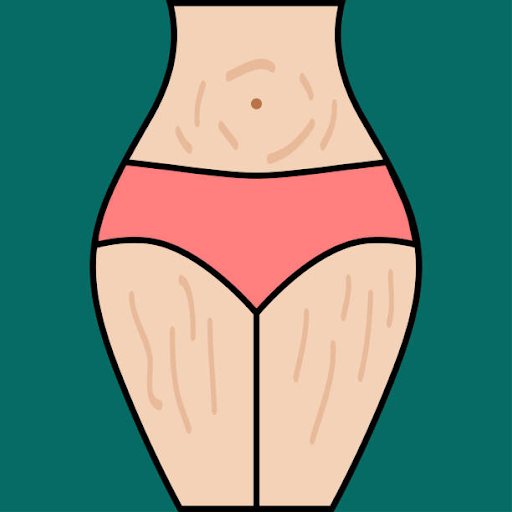 Remedies for Stretch Marks
