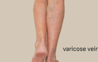 যখন-তখন শিরায় টান ধরে, নীল হয়ে ফুলে যাচ্ছে? আপনার ভেরিকোজ ভেইন নেই তো? 7 Varicose Veins