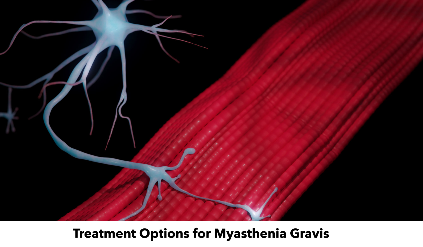myasthenia gravis treatment