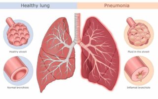 what is pneumonia